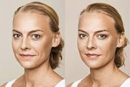 Rejuvenecimiento Facial en Madrid Dental Denche Rejuvenecimiento Facial en Madrid