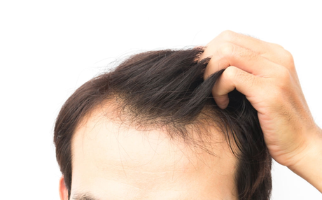 La solución ideal para la alopecia, según clínica injerto capilar