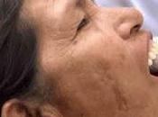 Adultos mayores reciben prótesis dental…