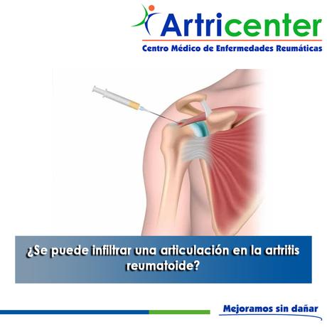 Artricenter: ¿Se puede infiltrar una articulación en la artritis reumatoide? Artricenter: ¿Se puede infiltrar una articulación en la artritis reumatoide?