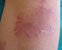 tina Remedio natural para la tiña