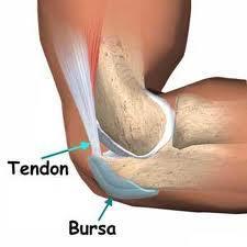 bursitis Tratamientos naturales de la bursitis