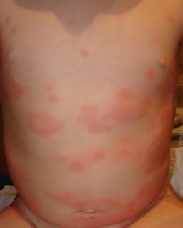 Urticaria