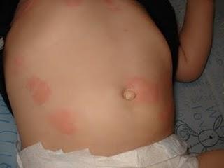 Urticaria