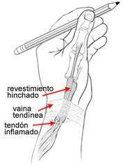 ¿Sufres tendinitis?