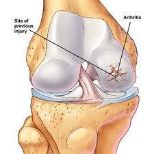 Nuevo chip para predecir la evolución de la artrosis en rodilla