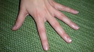 Dos especialistas en dermatología desmontan las leyendas sobre el origen de la leuconiquia