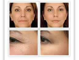 Ácido Hialurónico  ¡Luce espectacular!