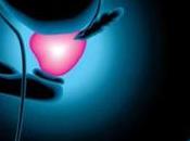 Síntomas cáncer próstata, informa Málaga