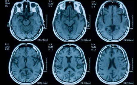 Un algoritmo detecta hemorragias cerebrales con más acierto que la mitad de los radiólogos Un algoritmo detecta hemorragias cerebrales con más acierto que la mitad de los radiólogos