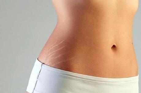 Lo que no sabías de las estrías como elminar estrias