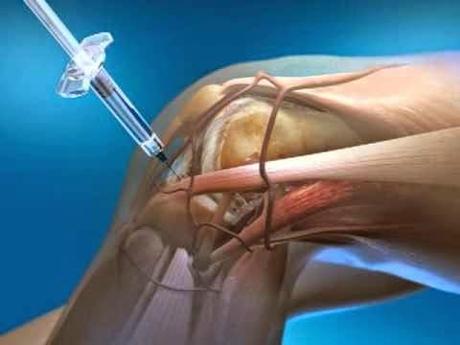 El Ácido hialurónico para la rodilla, la cara y muchos usos más acido hialuronico efectos secundarios