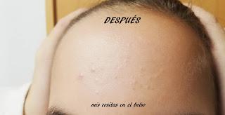 Cuidamos nuestro acné