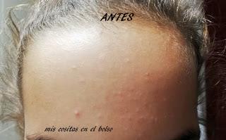 Cuidamos nuestro acné