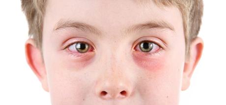 Conjuntivitis infantil ¿Qué es?