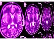 Vinculan genéticamente autismo síndrome Tourette