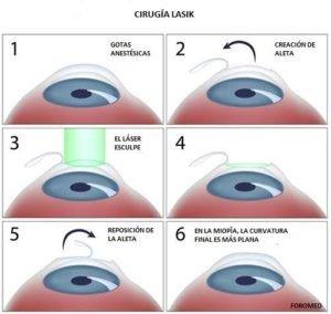 LASIK