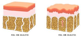 Celulitis, como prevenir la celulitis, Como quitar la celulitis, Diferencia entre celulitis y grasa, Grasa, Que es la celulitis, Vivir saludablemente, 