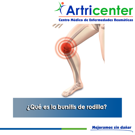 Artricenter: ¿Qué es la bursitis de rodilla?