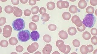 Cientíificos españoles identifican cuatro nuevos genes que provocan el desarrollo del cáncer hematológico