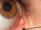 ¿Cuándo obstruye lacrimal?