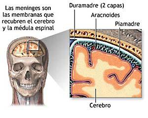 Meningitis por meningococo