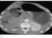 Diagnóstico tomográfico neumatosis intestinal