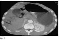 Diagnóstico tomográfico de la neumatosis intestinal