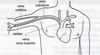 Profilaxis antibiótica en la colocación de puertos de acceso venoso central