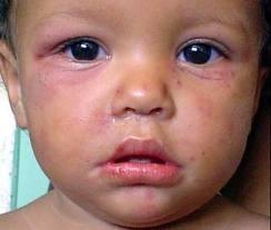 enfermedadkawasaki Las características de la enfermedad de Kawasaki