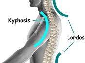 lordosis