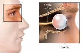 ¿En qué consiste la neuritis óptica?