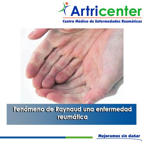 Artricenter: Fenómeno de Raynaud una enfermedad reumática