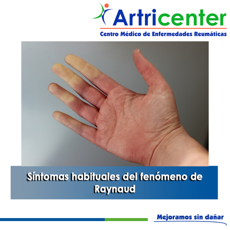 Artricenter: Síntomas habituales del fenómeno de Raynaud Artricenter: Síntomas habituales del fenómeno de Raynaud