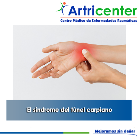 Artricenter: El síndrome del túnel carpiano