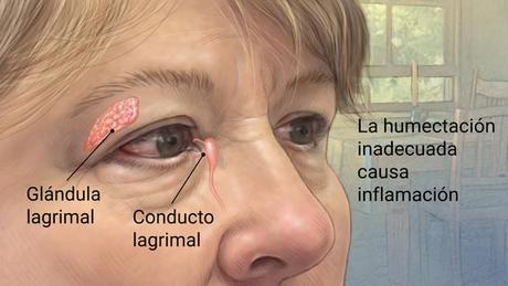 #Salud:  Más del 60 por ciento de la población joven en #México padece Ojo Seco