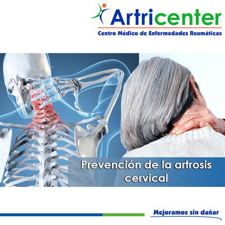 prevención artrosis-ARTRICENTER-BLOG.png