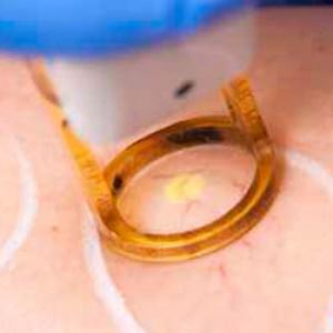 ¿Sabes cómo se quitan las antiestéticas venas de la cara con láser?