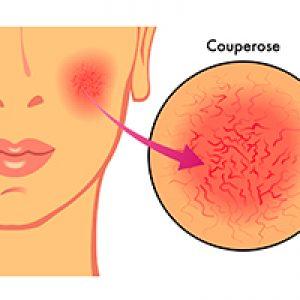 ¿Sabes cómo se quitan las antiestéticas venas de la cara con láser?