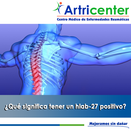 Artricenter: ¿Qué significa tener un hlab-27 positivo?