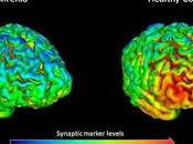 pacientes esquizofrenia tienen menos conexiones cerebrales