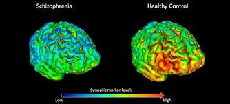 Los pacientes con esquizofrenia tienen menos conexiones cerebrales