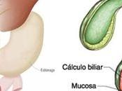 ¿Cómo presenta colecistitis Aguda?