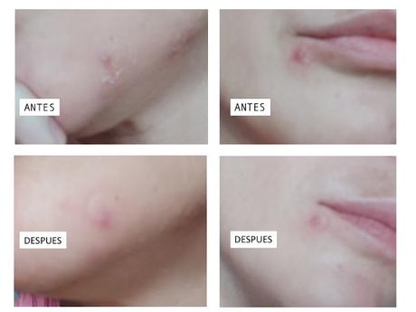 Productos para tratar granos: 3 opciones Productos para tratar granos: 3 opciones