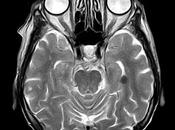 Imágenes cerebrales como herramientas diagnóstico para trastornos mentales