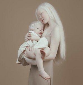 Hermanas albinas con 12 años de diferencia deleitan a todo Internet con sus fotos