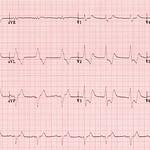 ecg