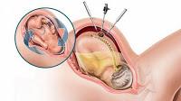 Beneficios de la Cirugía Prenatal para la Espina Bífida