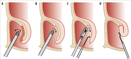 ¿Es recomendable operarse de rinitis crónica?
