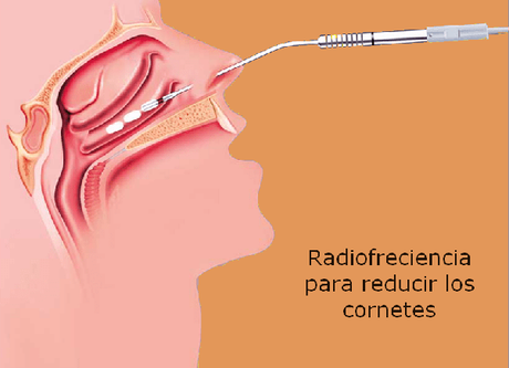 ¿Es recomendable operarse de rinitis crónica?